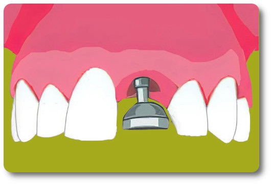 Implants dentaires Crolles