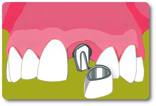 Implants dentaires Crolles