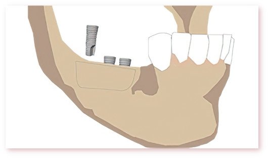 chirurgien dentiste Crolles