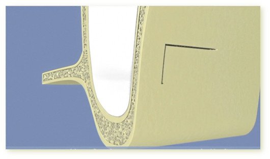 Greffe osseuse sinus 03