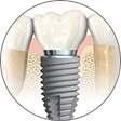 Implantologie dentaire Crolles