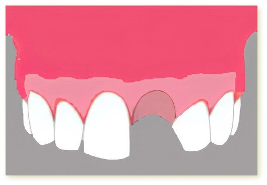 implants dentaires Crolles