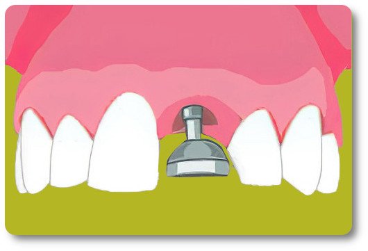 Implants dentaires Crolles