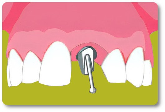 Implants dentaires Isère