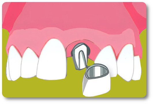 Implants dentaires Crolles