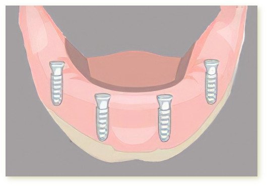 Implants dentaires Isère