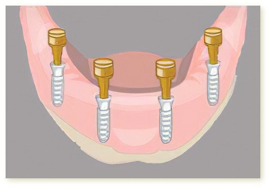 Implants dentaires Crolles