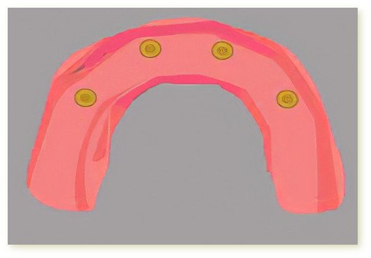 Implants dentaires Isère