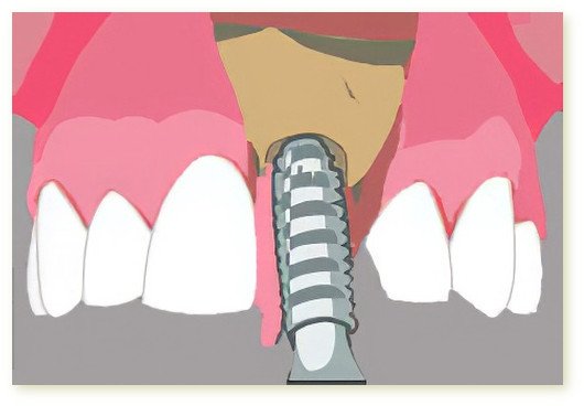 implants dentaires Isère