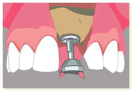Implants dentaires Isère